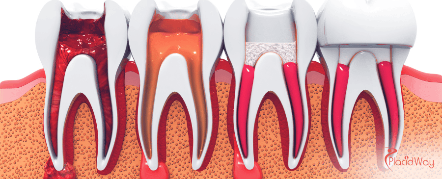 Affordable Root Canal in Mexico