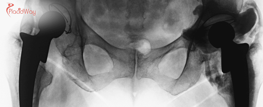 Total Hip Replacement in Turkey