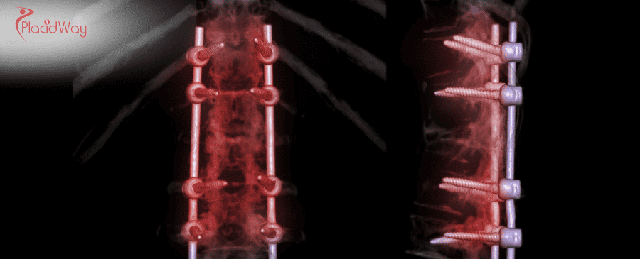 Spinal Fusion Surgery in Turkey
