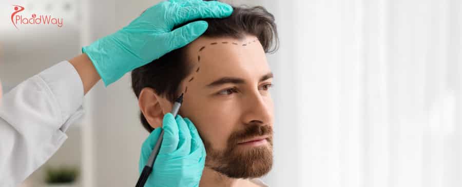 Hair Transplant in Turkey