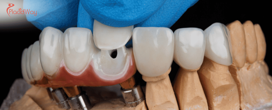 Dental Crowns in Mexico