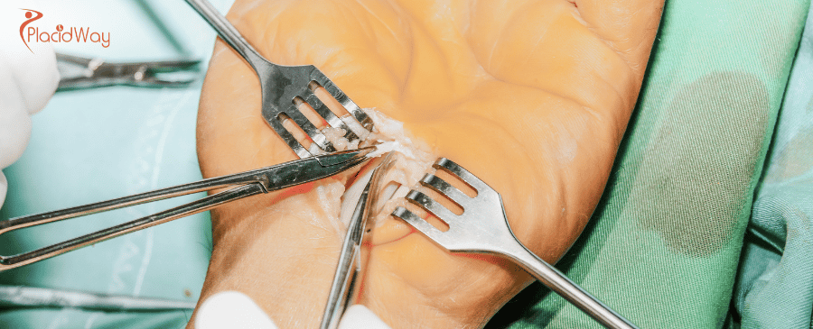 Affordable Carpal Tunnel Surgery in Turkey