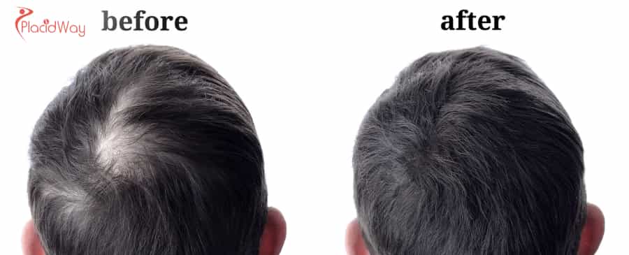 FUE Hair Transplant in Mexico 