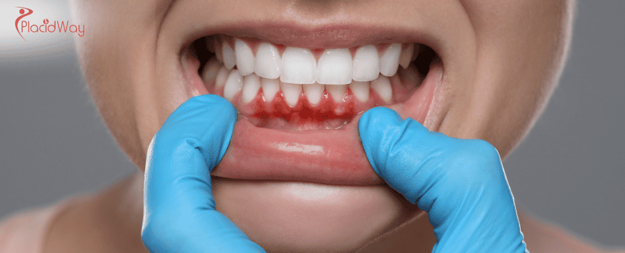 Gum Contouring in Colombia