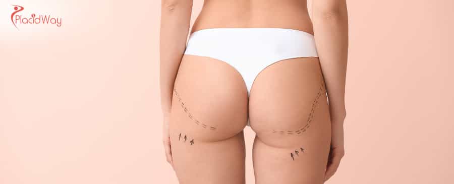 Buttock Reduction in Thailand