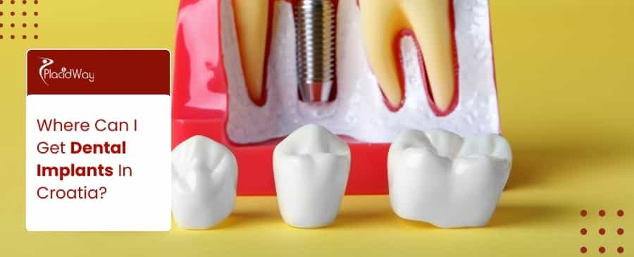 Dental Implants In Croatia