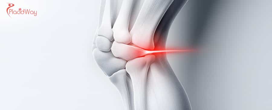 Stem Cell Therapy for Knee Osteoarthritis in Malaysia