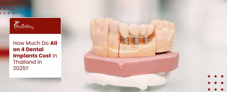 All on 4 Dental Implants Cost