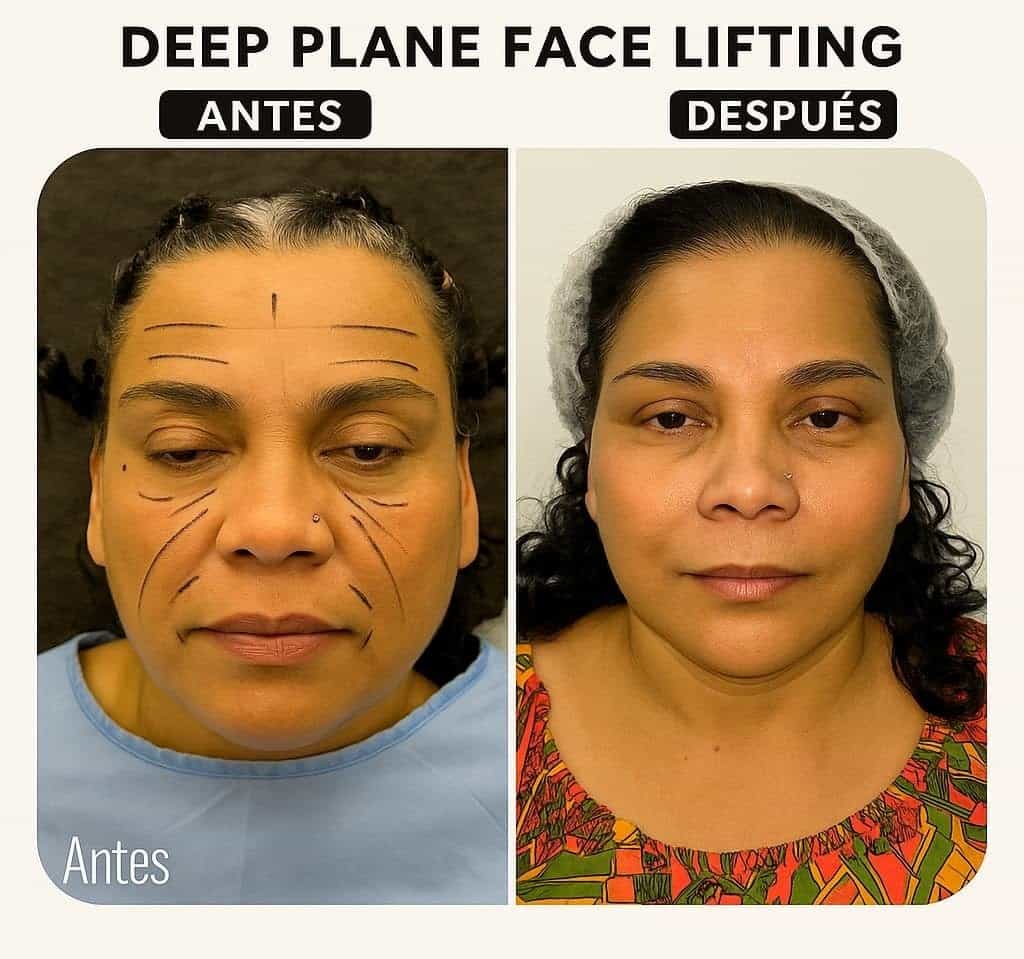Imagen de antes y después: lifting facial profundo en México