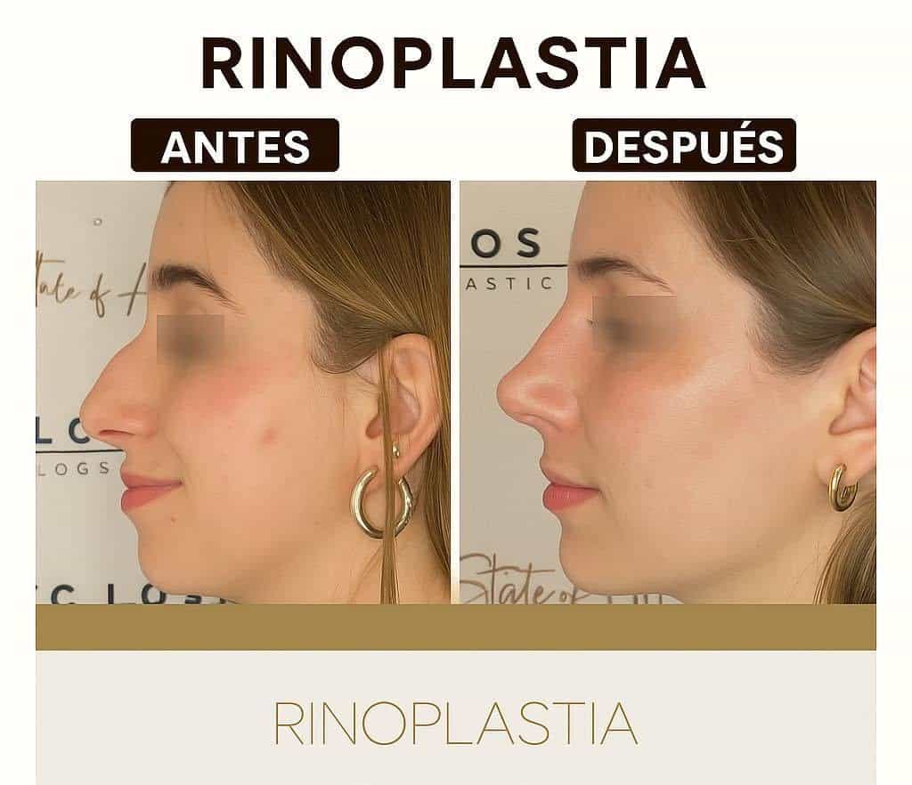 Imagen de antes y después - Rinoplastia en México