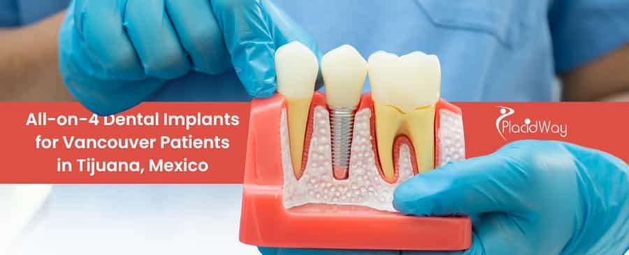 All-on-4 Dental Implants for Vancouver Patients in Tijuana, Mexico