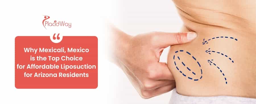 Why Mexicali, Mexico is the Top Choice for Affordable Liposuction for Arizona Residents
