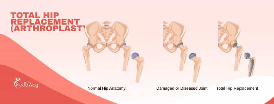 Total Hip Replacement or Arthroplasty