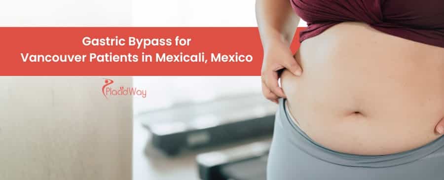 Bypass gástrico para pacientes de Vancouver en Mexicali, México