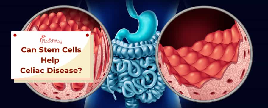 Stem Cells for Celiac Disease: