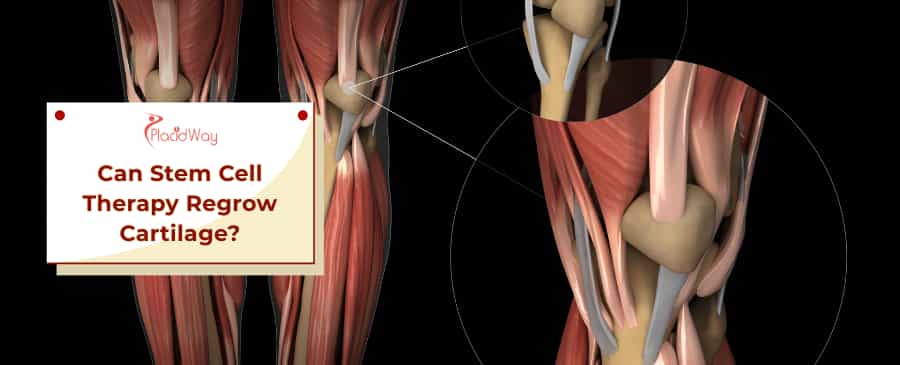 Stem Cell Therapy for Cartilage Regrowth
