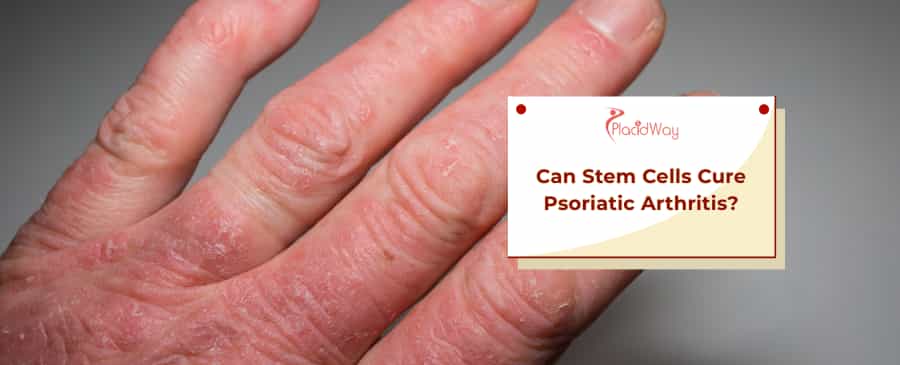 Stem Cells for Psoriatic Arthritis