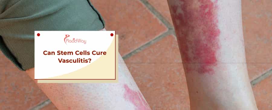 Stem Cells for Vasculitis