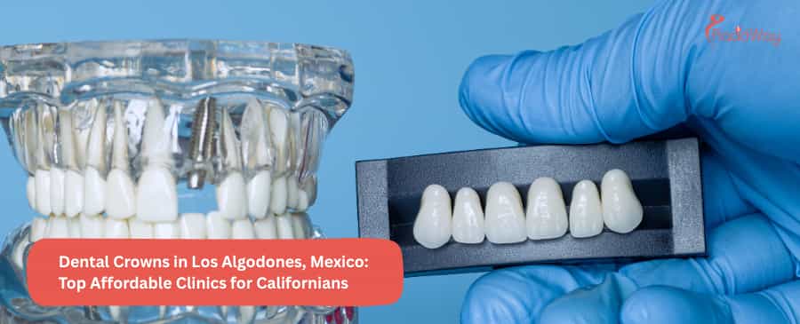 Dental Crowns in Los Algodones