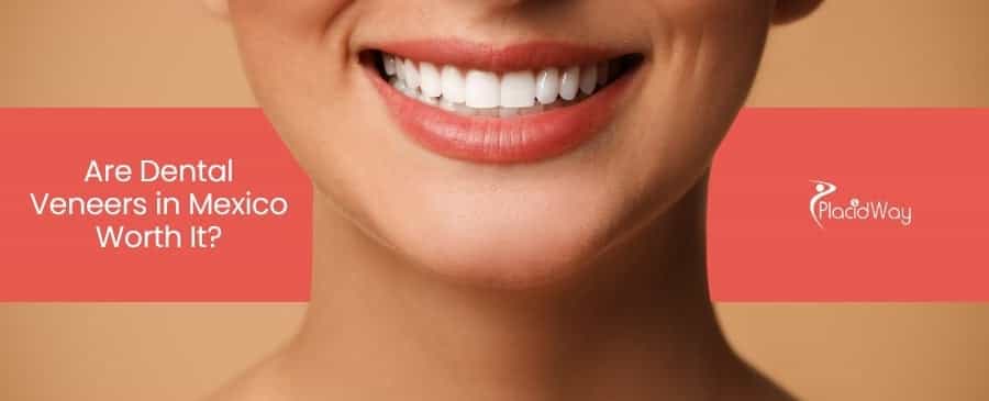 Dental Veneers in Mexico