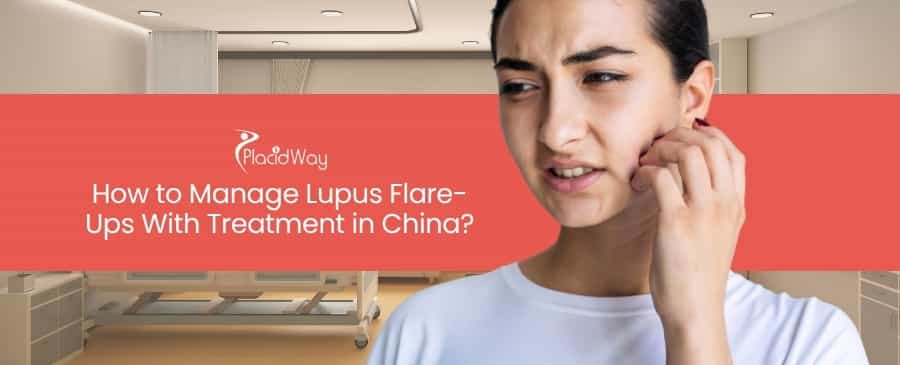Lupus Flare Ups With Treatment in China