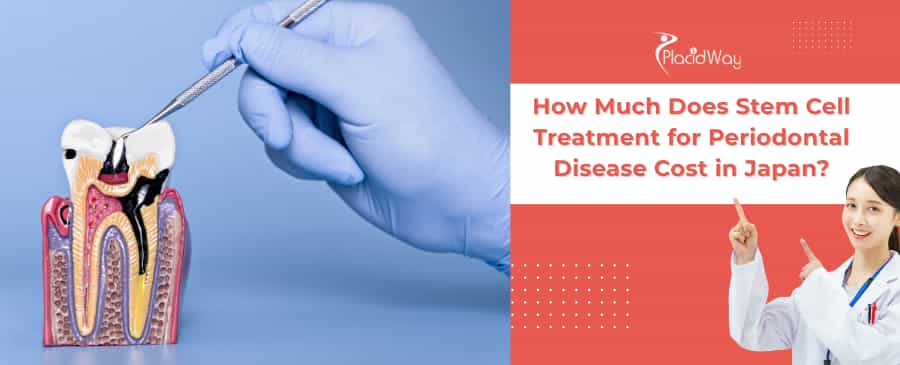 Stem Cell Treatment for Periodontal Disease in Japan
