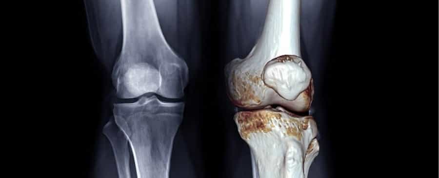 Knee Osteoarthritis Stem Cell Treatment in Mexico