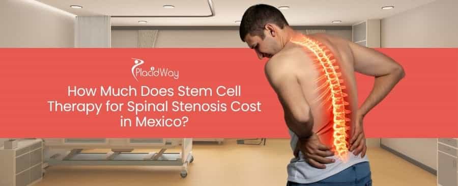 Stem Cell Therapy for Spinal Stenosis Cost in Mexico