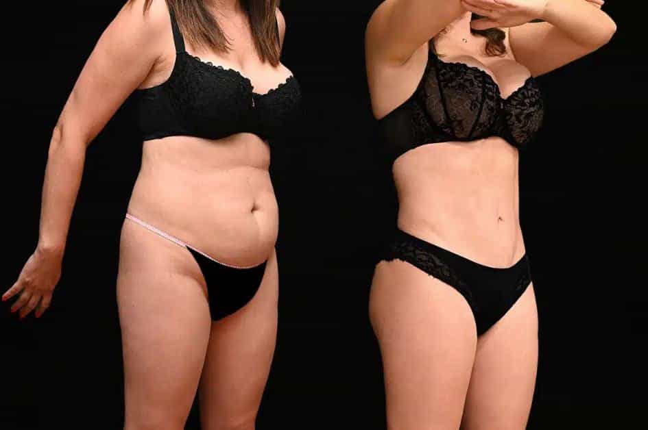 Before and After Image for Vaser Liposuction in Greece