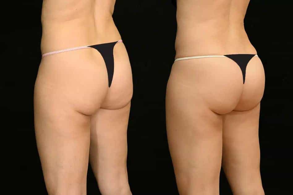 Before and After Image for Gynecomastia in Greece