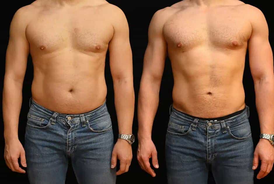 Before and After Image for Brazilian Butt Lift in Greece