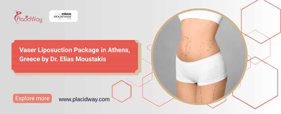 Vaser Liposuction Athens Greece | Dr. Elias Moustakis