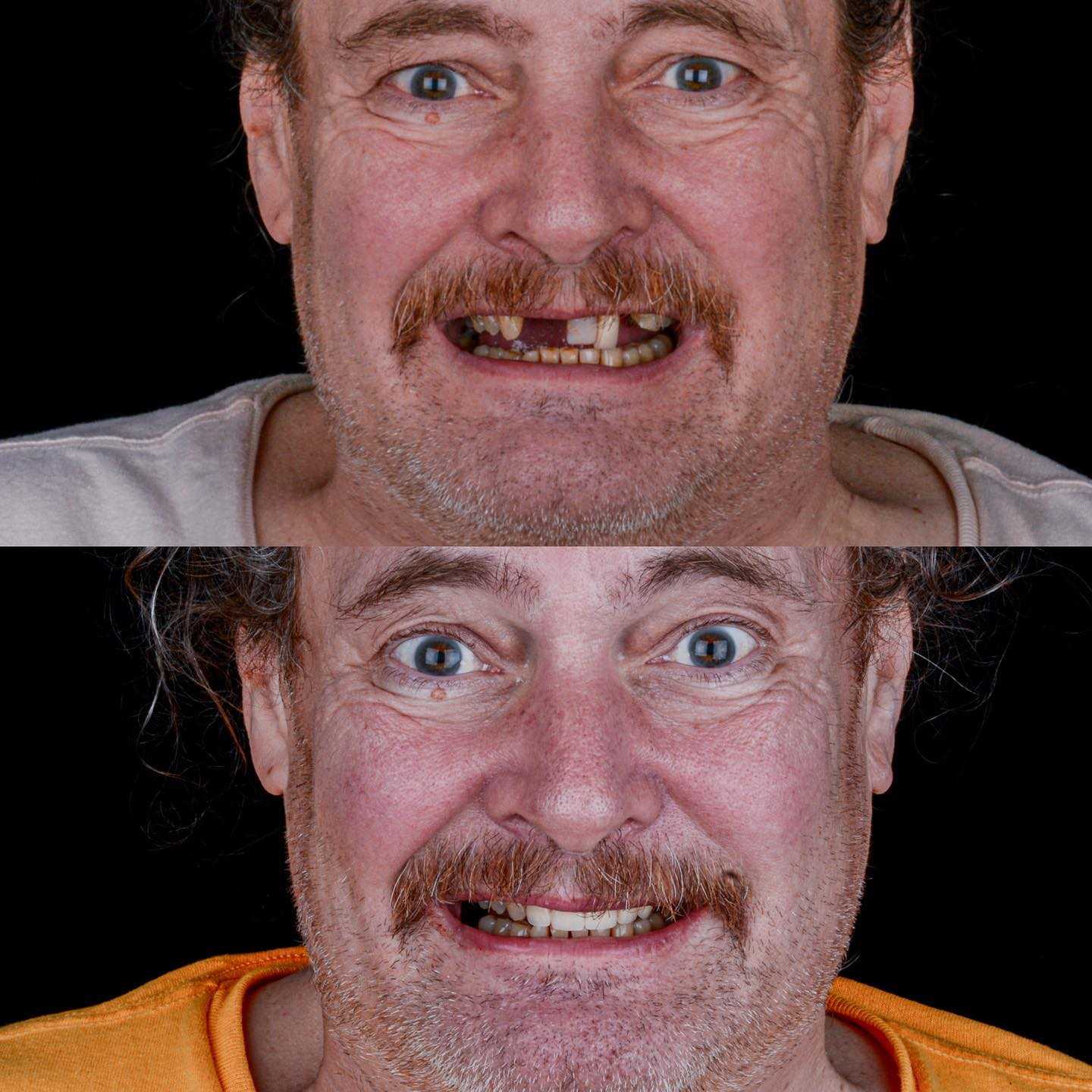 Before and After Full Mouth Restoration in Los Algodones Mexico