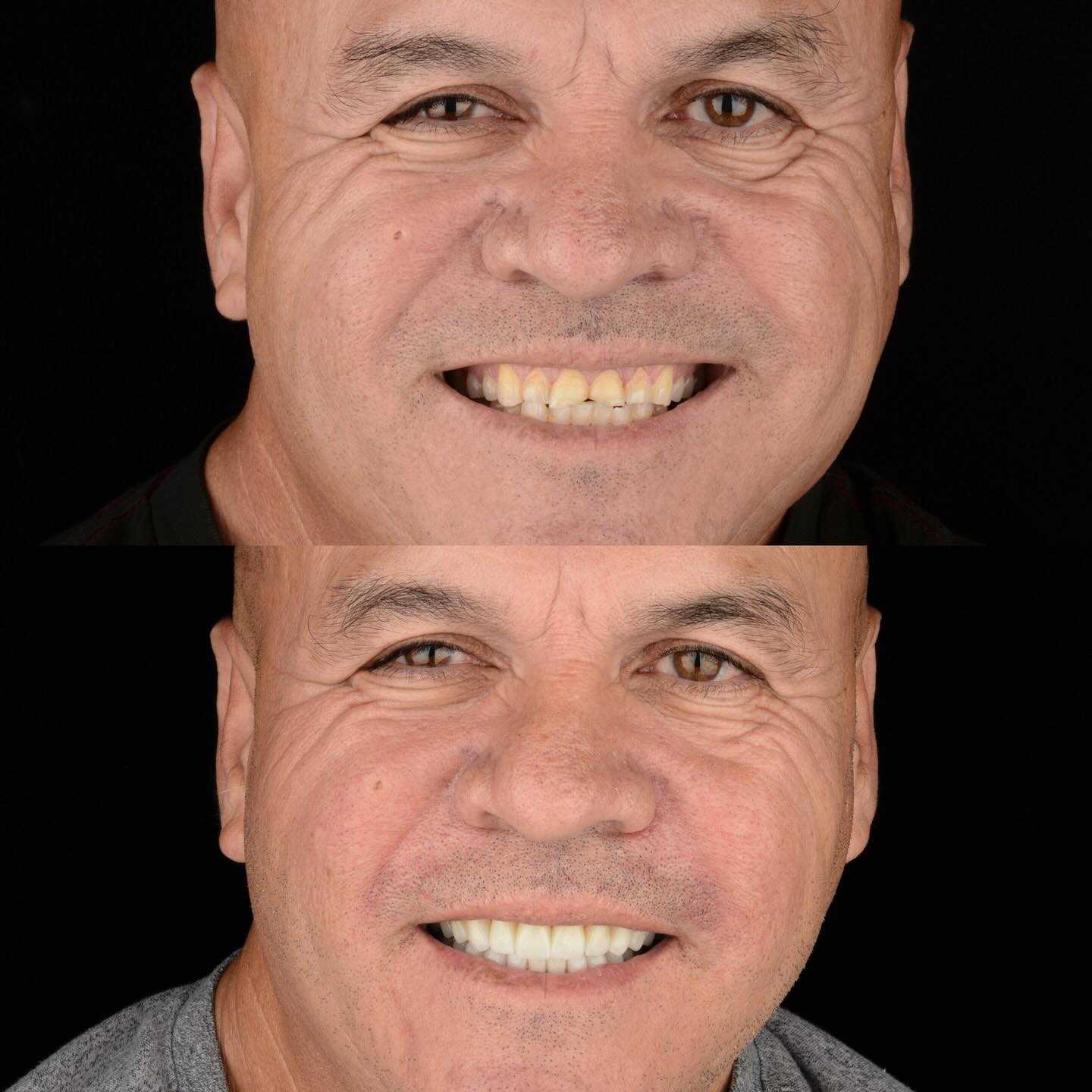 Before and After Smile Makeover in Los Algodones Mexico