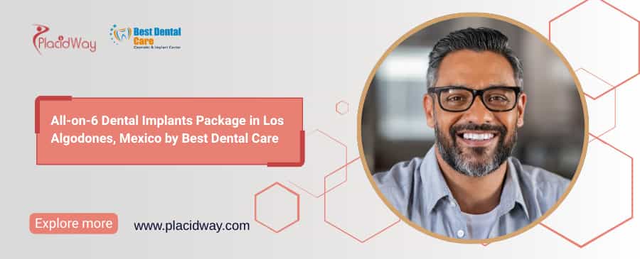 All-on-6 Dental Implants Los Algodones MX | Best Dental Care