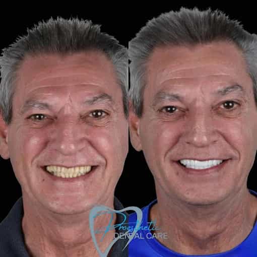 Antes Después Cambio de Imagen de Sonrisa en Los Algodones, México