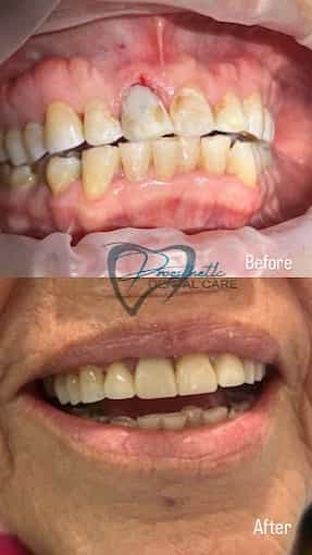 Antes y después de una reconstrucción bucal completa en Los Algodones, México