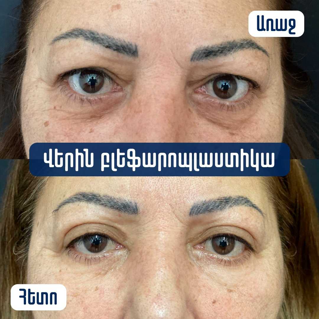 Before and After Eyelid Surgery in Armenia