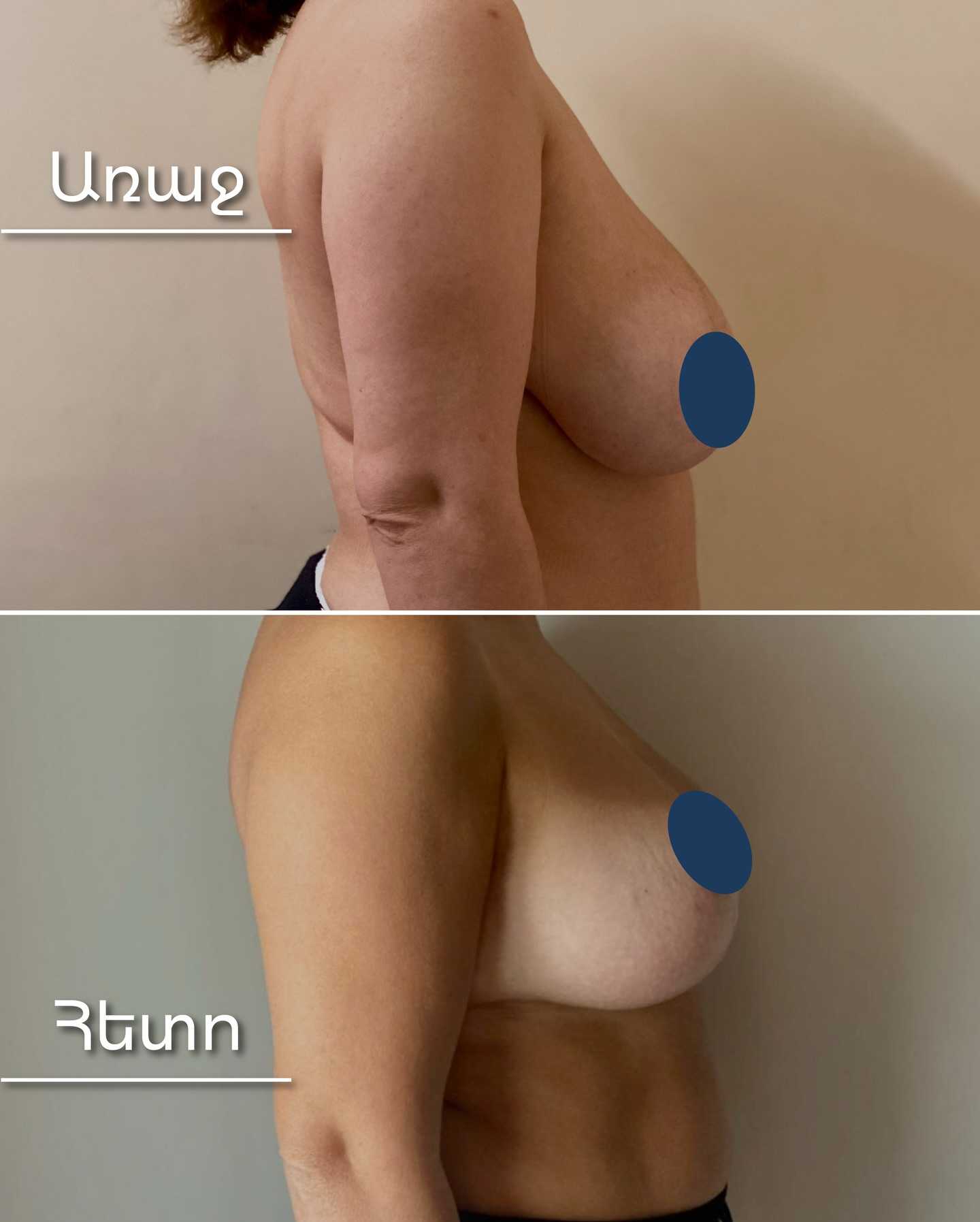 Before and After Breast Augmentation in Armenia