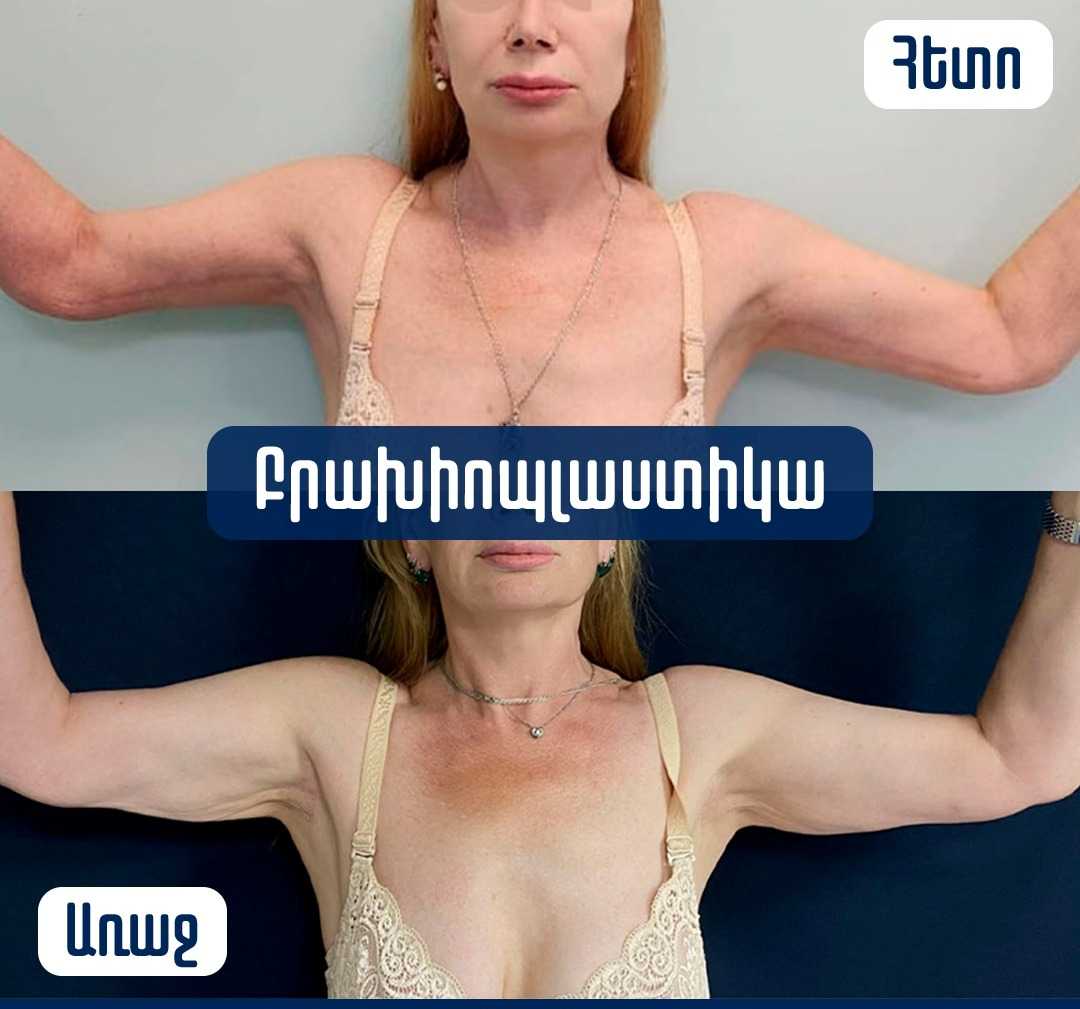 Before and After Brachioplasty in Armenia