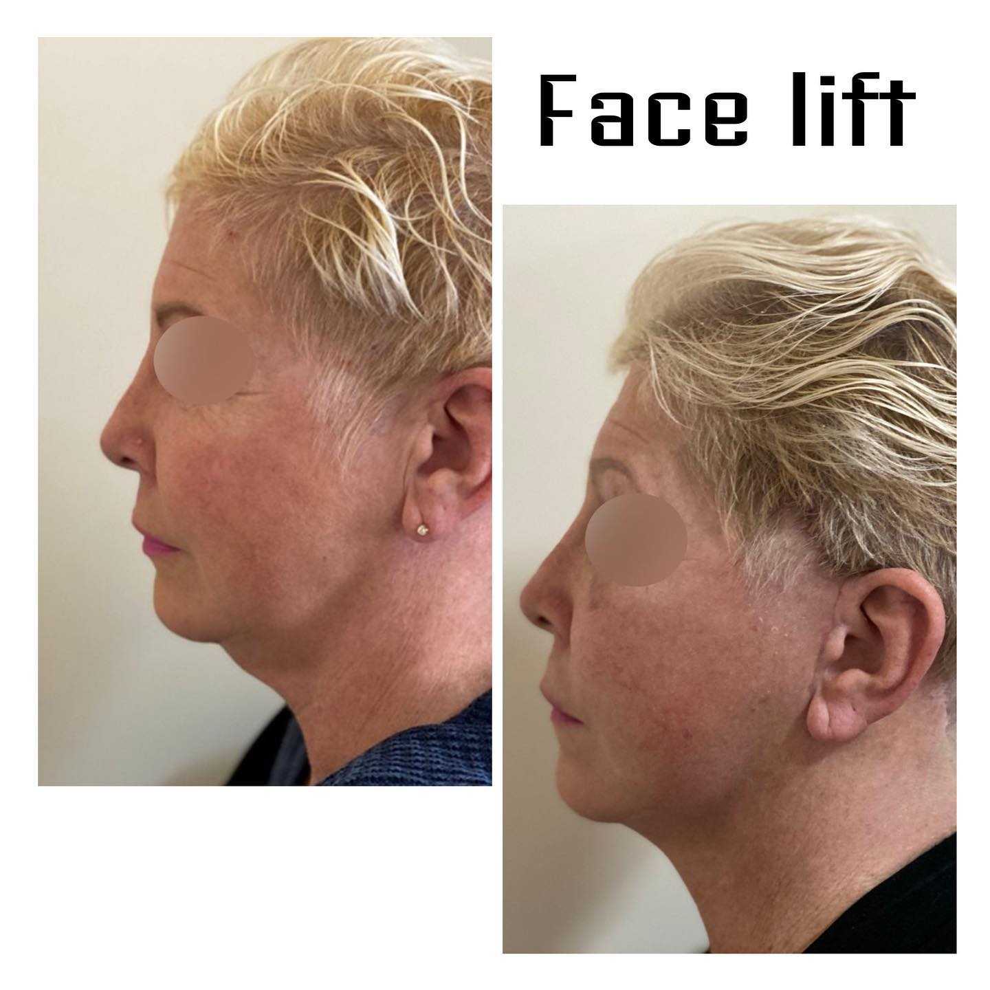 Before and After Facelift in Armenia