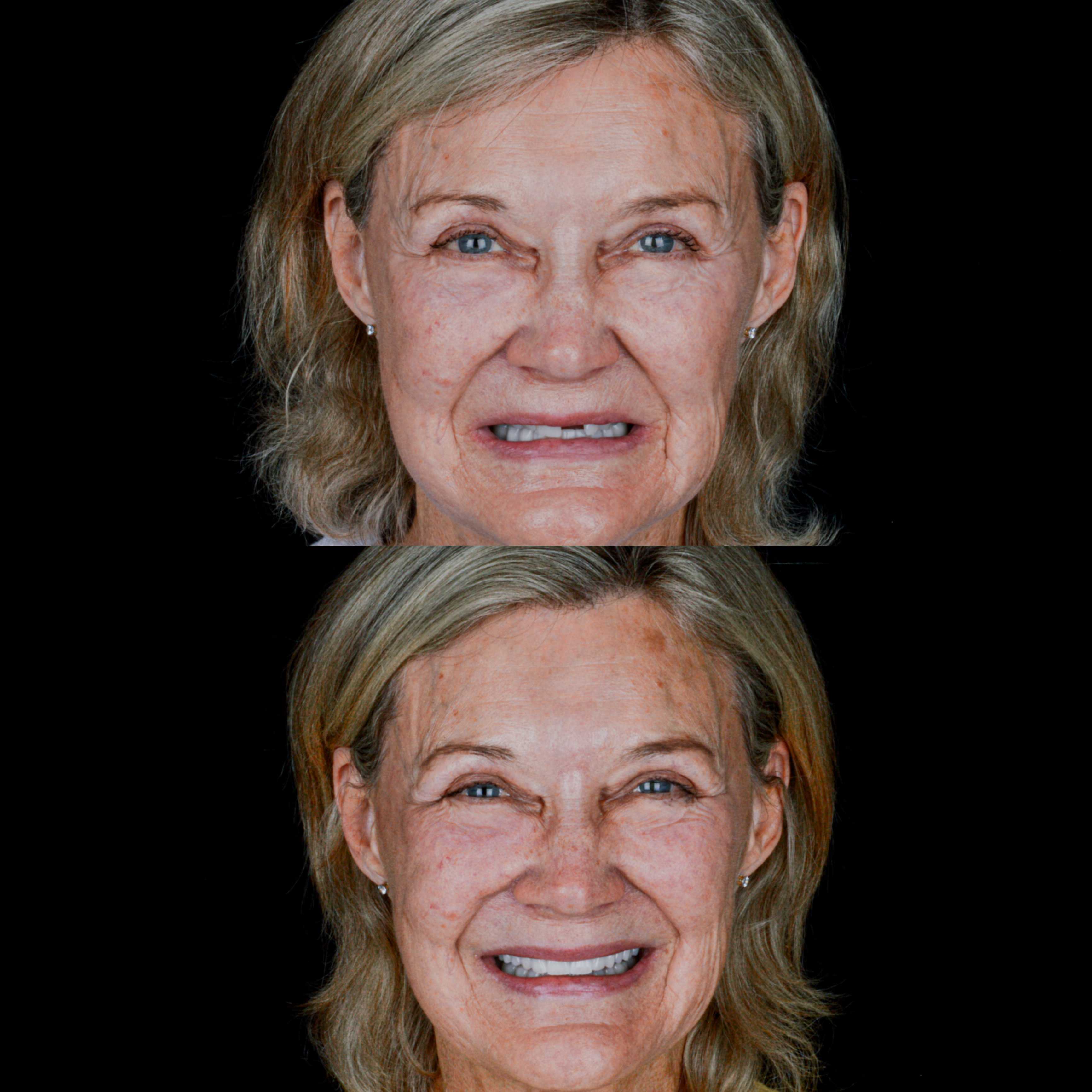 Before and After Smile Makeover in Los Algodones Mexico