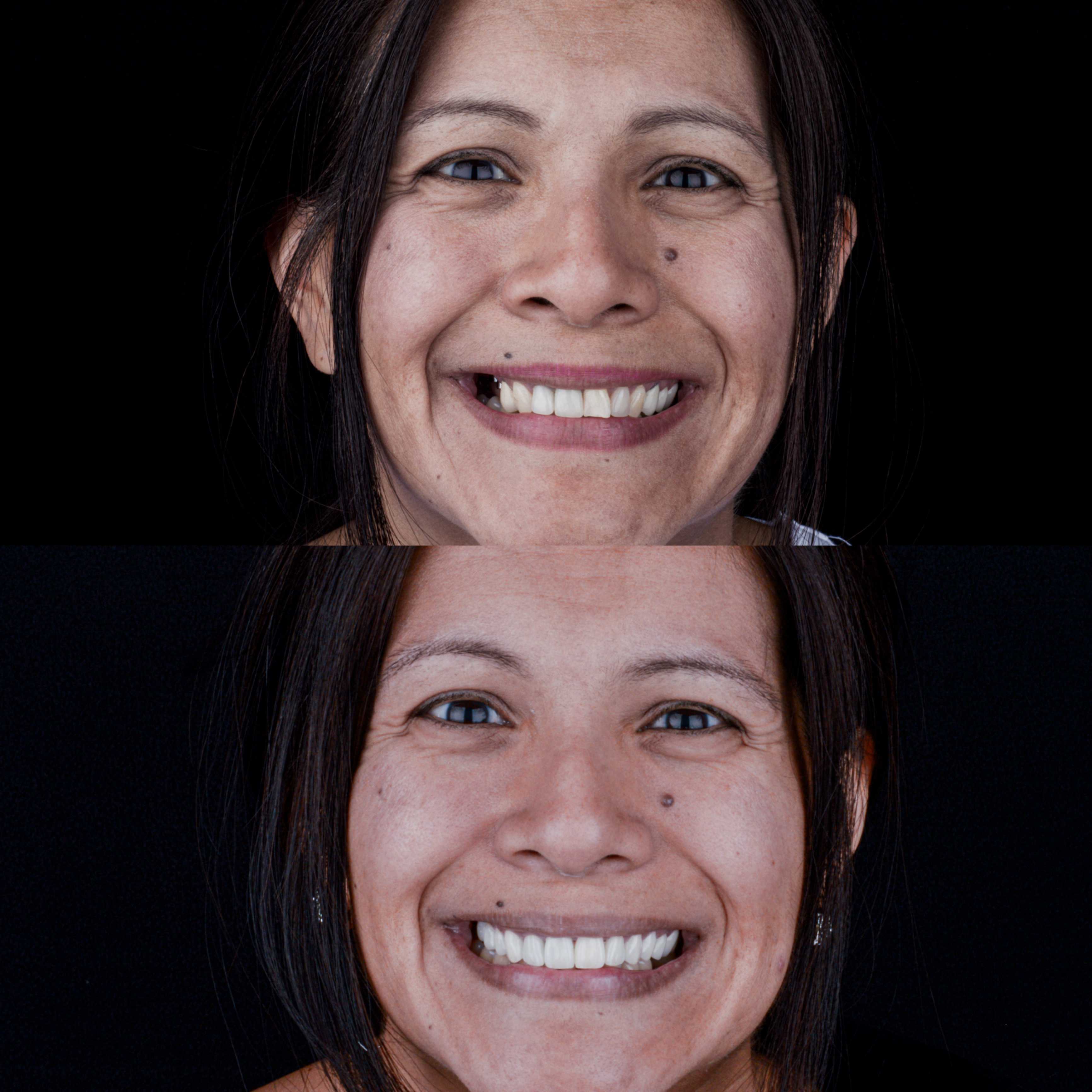 Before and After Smile Makeover in Los Algodones Mexico