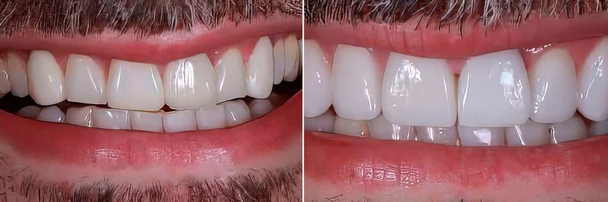 2-Smile Makeover in Shade 1M1 Veneers