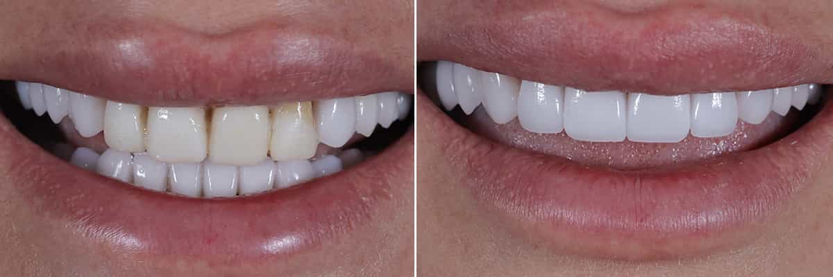 4-Increased Vertical Dimensions