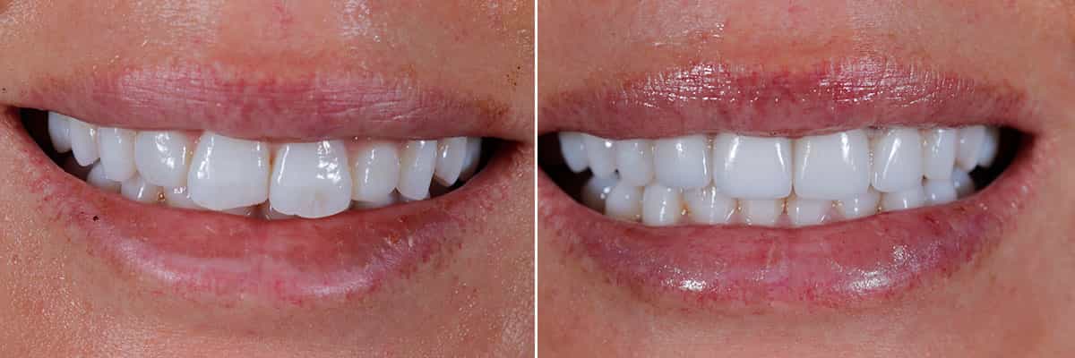 5-Perfectly Proportioned Smile Transformation