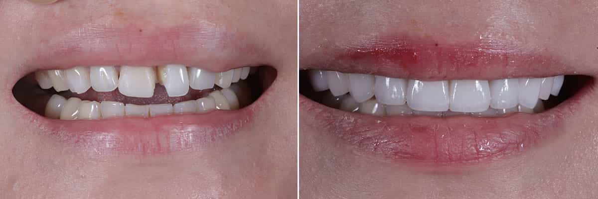 7-Veneers for A Smile Makeover