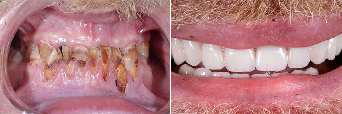 10-Full Mouth Rehabilitation