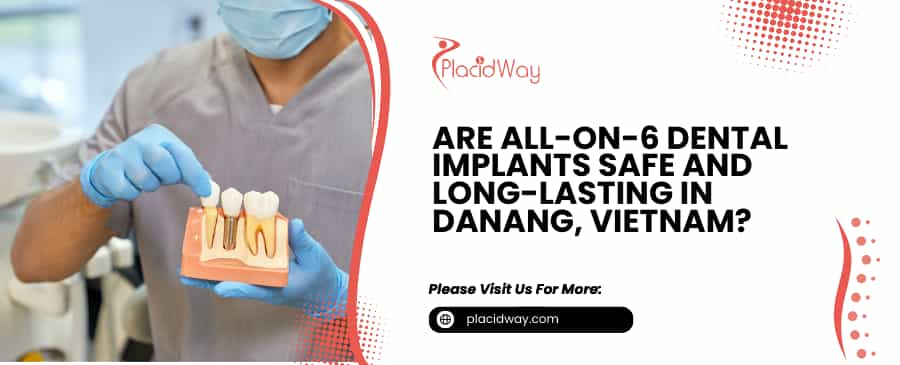 All-on-6 Dental Implants in DaNang, Vietnam