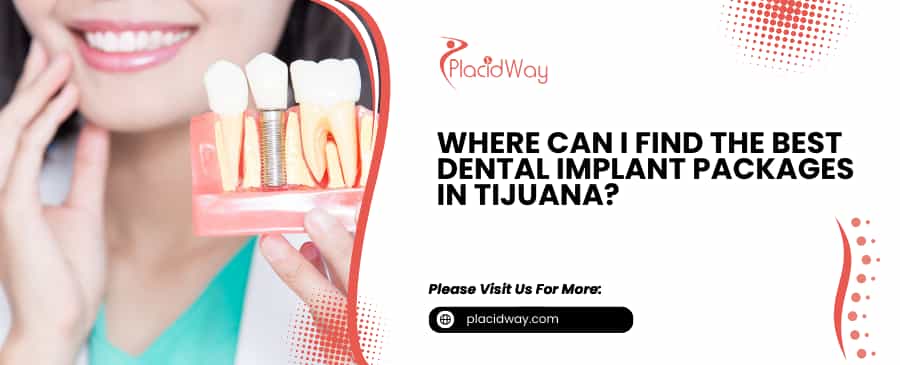 Best Dental Implant Packages in Tijuana